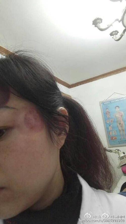 [转载]一人多图(2)——美女脑门拔罐静态全记录