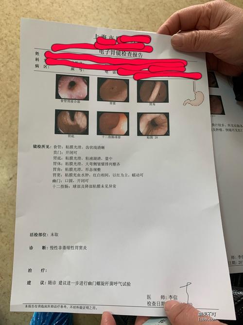 做了胃镜查出"慢性非萎缩性胃窦炎",这个毛病要紧吗?没有任何症状啊