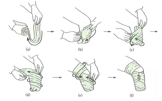 【四川省八一康复中心】战疫情:弹性绷带的使用——假肢康复训练及
