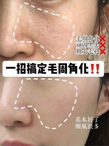 一招搞定毛周角化91进来学学哦9593从高中的就