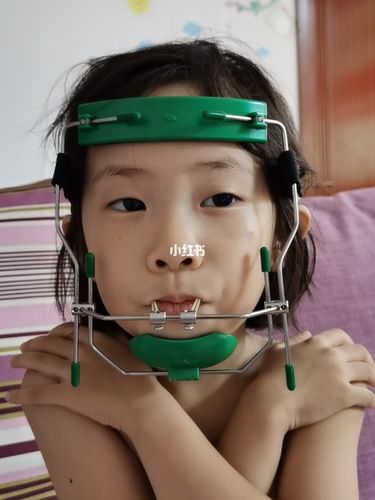 闺女的地包天牙齿矫正之路开始了_牙套_异物感_美妆