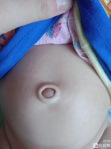 宝宝快三个月了肚脐是这样的正常么那