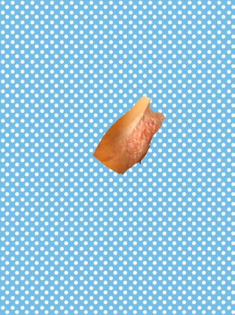 顺产侧切,大腿内侧不知道是什么东西,刀疤吗?【有图慎入】