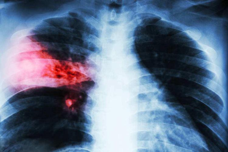 身体出现这5个信号, 可能是肺结核, 早点吃它可预防