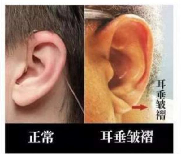 耳垂斜线皱纹,有,危险了!