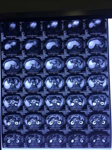 检查报告说肝s6段肝癌是肝癌吗如果是要怎样进行治疗陕西人在陕西哪