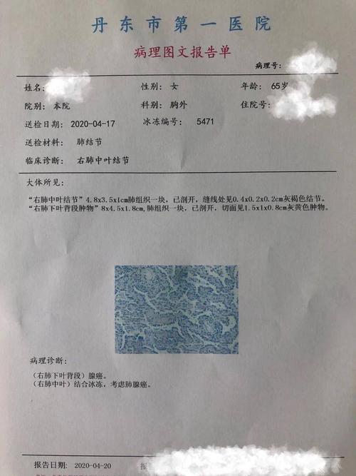 这位患者在我院胸外科行手术治疗,术后病理报告显示两个结节均为肺癌