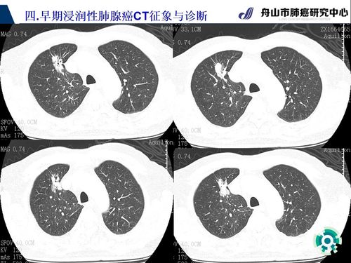 早期肺腺癌ct表现之早期浸润性肺腺癌