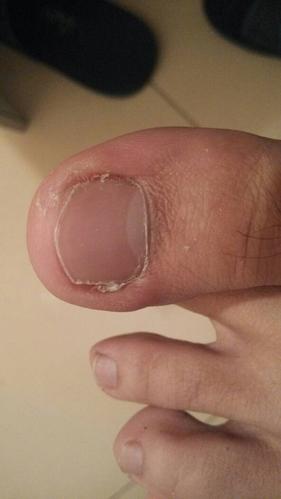 这种是甲沟炎初期症状吗?就是一用手稍微用力碰下就有