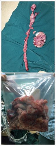 挑战四级手术,腹腔镜下子宫全切切出新高度