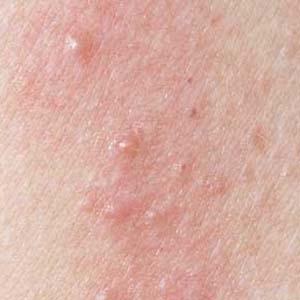 轻度湿疹症状图片