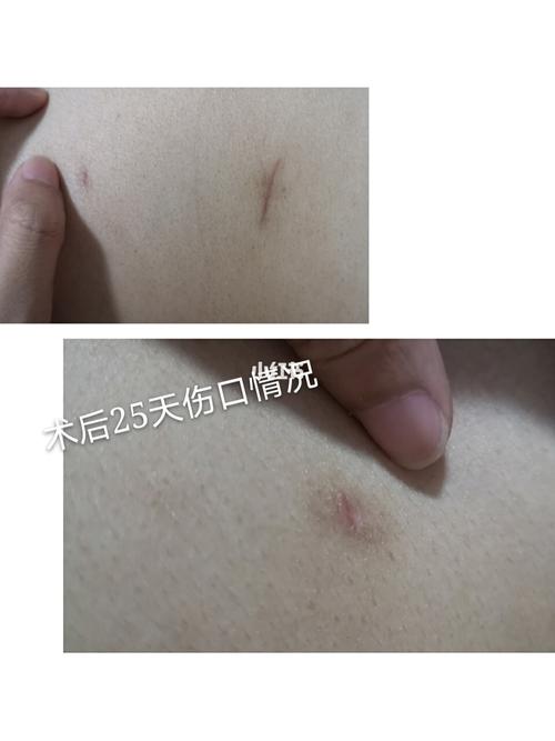 巧克力囊肿腹腔镜手术后疤痕恢复_巧克力_疤痕_祛疤膏_破腹产_巧克力