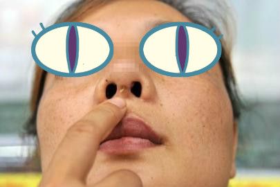 假体隆鼻出现穿孔