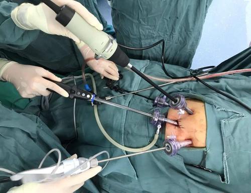 子宫肌瘤腹腔镜手术前后注意事项!