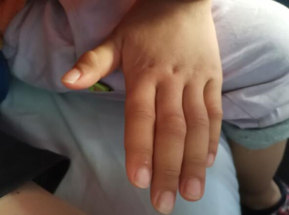 四岁男童在蟹子湾公园玩水,十指关节肿成成人粗