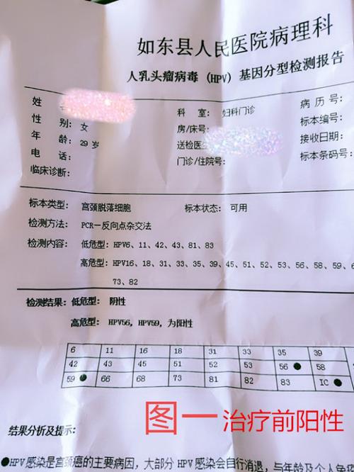 如东县夏女士hpv56,hpv59型高危转阴病例分享