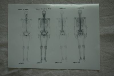 这是我的骨扫描图片.