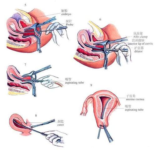 药流清宫后多久可以怀孕呢?各位辣妈知道吗?