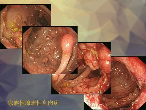 【消化一科】胃癌的近亲——胃息肉,你了解多少?