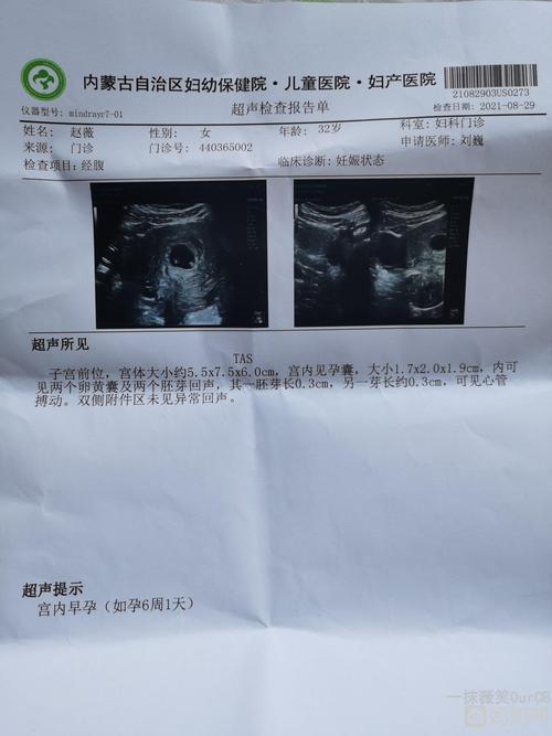 今天又去做了一个b超,哈哈说是双胞胎太激