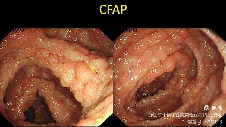 普外二科之——什么样的肠息肉最危险!