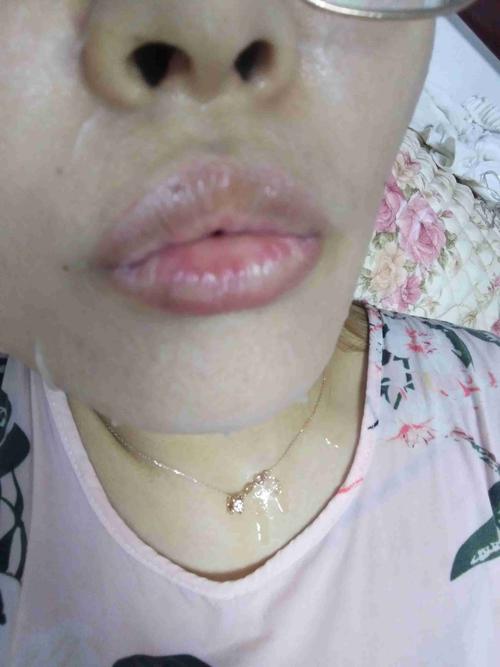 嘴唇上的白斑是什么?