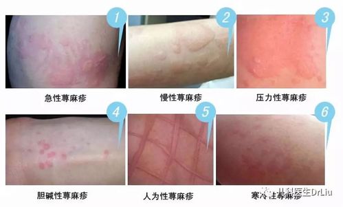 荨麻疹对抗过敏药有抗药性怎么办,荨麻疹老是不好怎么