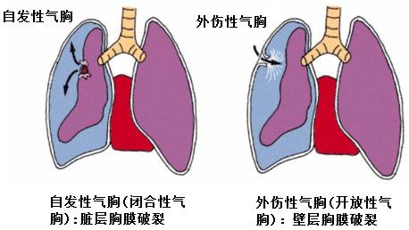 气胸常见问题