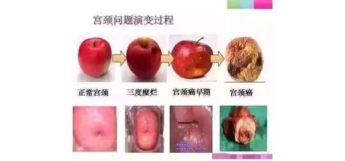 📢📢📢【关于宫颈糜烂,医院不愿意告诉你的那些