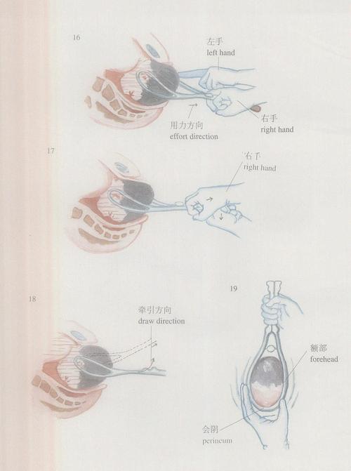 双叶产钳:亦是在切开子宫,破膜后施术,如胎头位置较高时,首先将胎头转