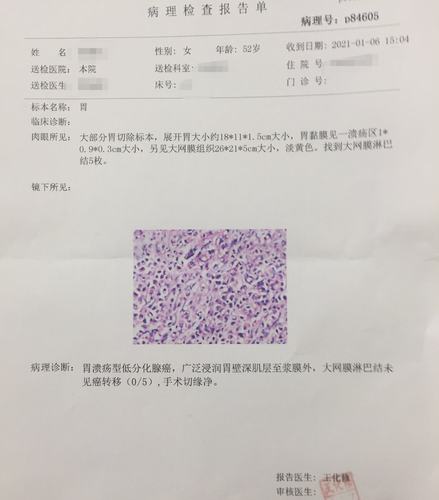 "小窟窿"根治胃癌,术后不再"大切口"!