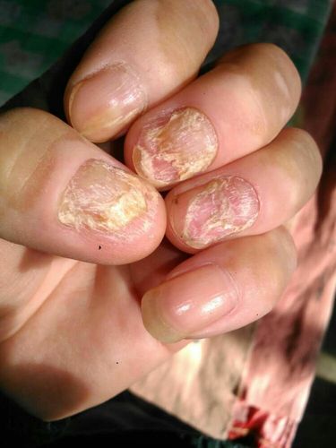 专业治疗～灰指甲～鸡眼～脚气～甲沟炎～手足癣～臭脚～烂脚丫等请