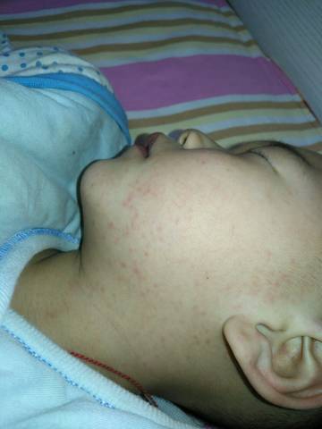 27个月了,身上脸上出的小红点,从昨天开始,越来越多,前天晚上开始发烧