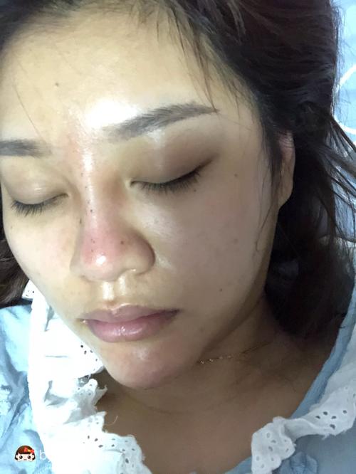 鼻子和下巴打了玻尿酸第一天鼻子是不是打坏了怎么这样我问医生她说是