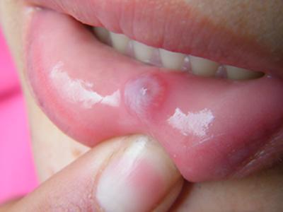 粘液腺囊肿的基本概述