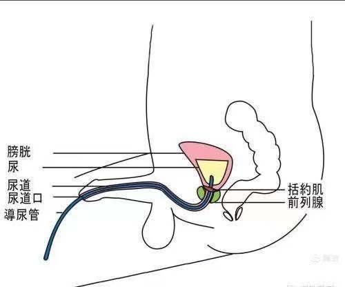 一次性尿管的妙用---间歇导尿