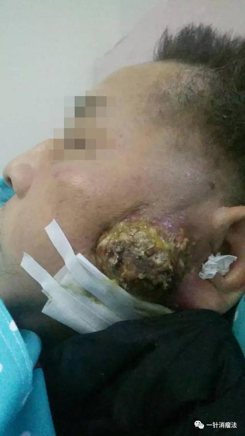 患者胡先生,3年前被确诊鼻咽癌,曾在国内某大型肿瘤医院做了12次化疗