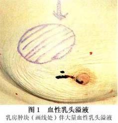 乳头溢液