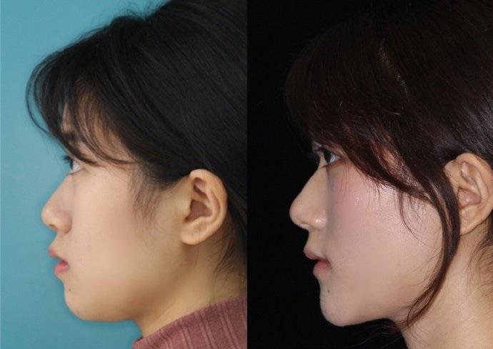 凸嘴下巴后缩,矫正牙齿有用吗?矫正了一定会变好看吗?