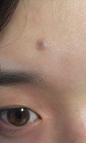 额头上有一个因为痘痘被扣掉后留下了一个黑色的疤痕,有两年多了 一直