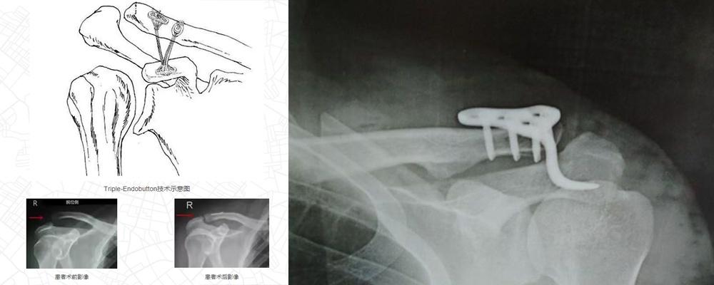 肩锁关节脱位不是只有一种手术