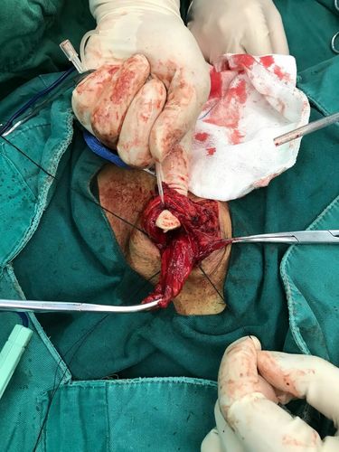 右侧腹股沟复发疝修补