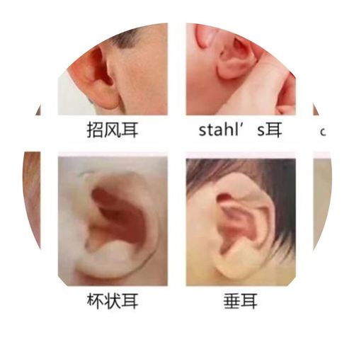 婴儿耳朵矫正器防耳贴塑型新生定型耳畸形硅胶的耳廓新生儿招风耳
