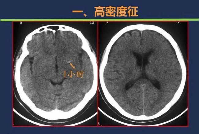 头颅ct如何预判超早期脑梗死