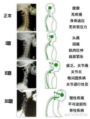 颈椎病的日常护理有哪些