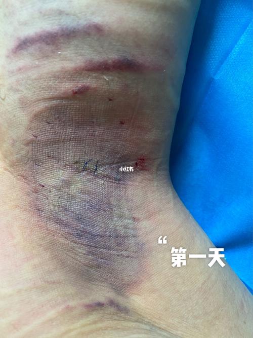 腋下狐臭手术_狐臭_裙子_裤子_美白霜_医疗健康_医疗