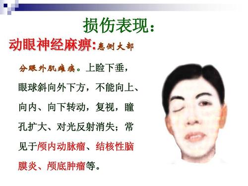 动眼神经损伤