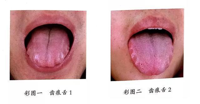 舌头两侧齿痕大于这个数,说明脾虚较