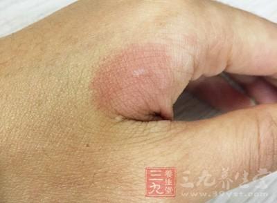蜜蜂蛰了怎么办 蜜蜂蛰伤后处理措施