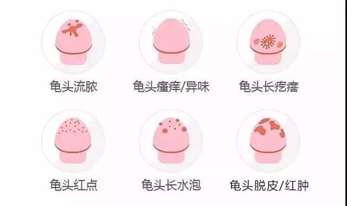 包皮龟头炎夏季高发期包皮过长患者要注意